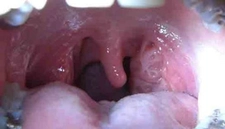 Bademcik Beyazlaması Nedenleri?