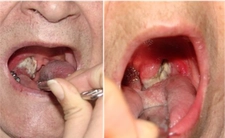 Bademcik Kanseri Belirtileri ve Tedavisi